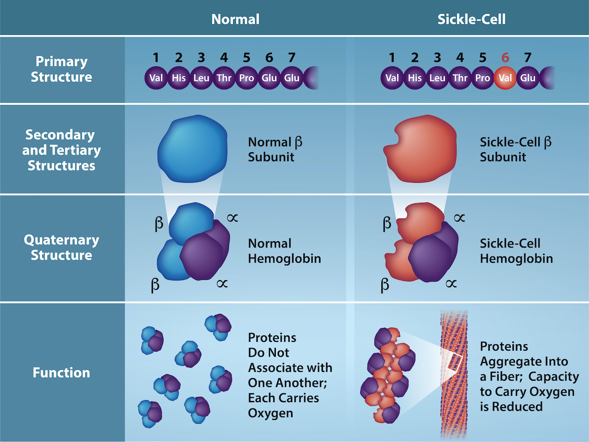 Normal vs Sickle Red Blood Cell